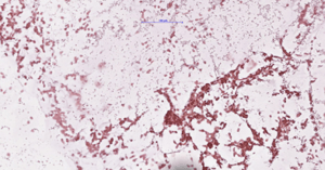 carcinoma-img-1