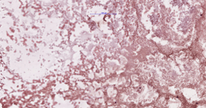 carcinoma-img-2