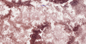 carcinoma-img-3
